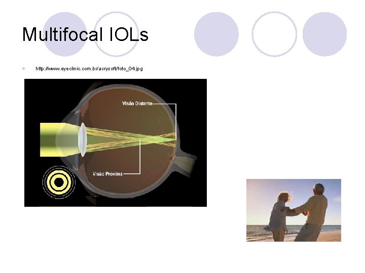 Multifocal IOLs l http: //www. eyeclinic. com. br/acrysoft/foto_04. jpg 