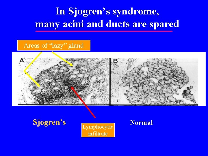 In Sjogren’s syndrome, many acini and ducts are spared Areas of “lazy” gland Sjogren’s