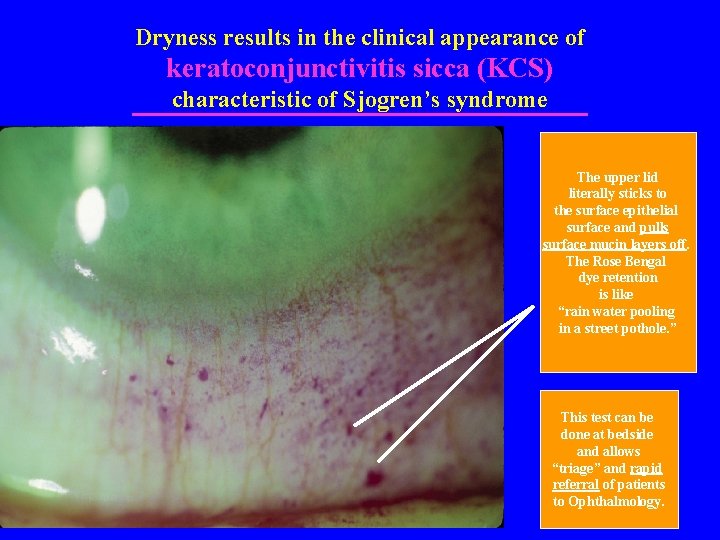 Dryness results in the clinical appearance of keratoconjunctivitis sicca (KCS) characteristic of Sjogren’s syndrome