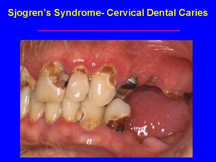 Sjogren’s Syndrome- Cervical Dental Caries 
