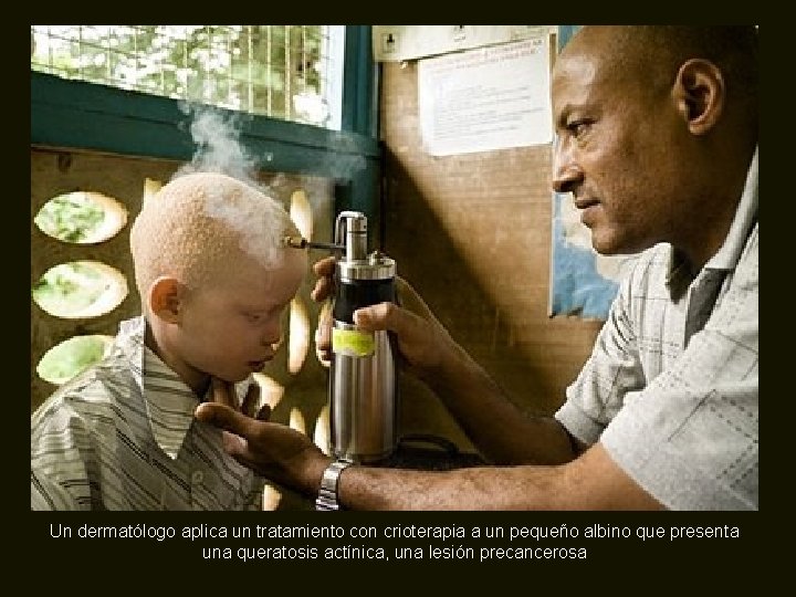 Un dermatólogo aplica un tratamiento con crioterapia a un pequeño albino que presenta una