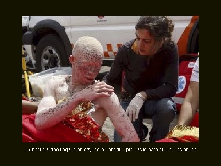 Un negro albino llegado en cayuco a Tenerife, pide asilo para huir de los