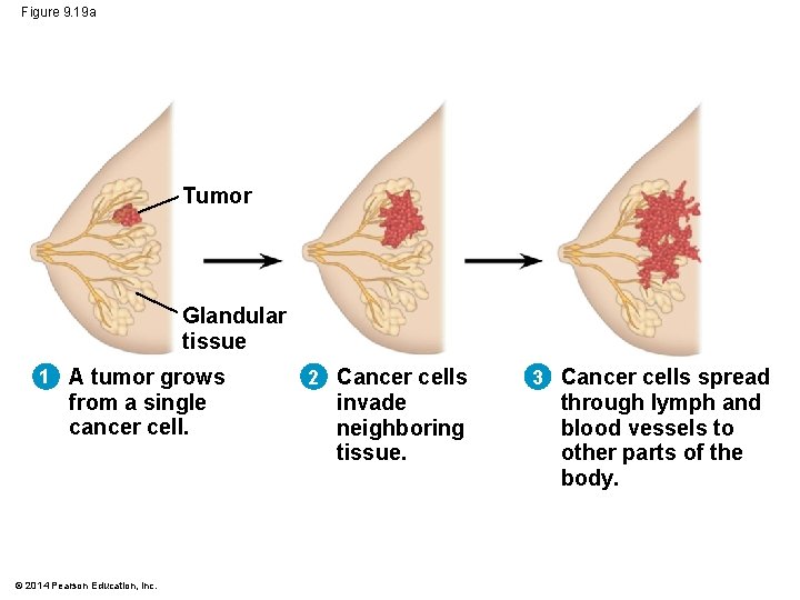 Figure 9. 19 a Tumor Glandular tissue 1 A tumor grows from a single Figure 9. 19 a Tumor Glandular tissue 1 A tumor grows from a single