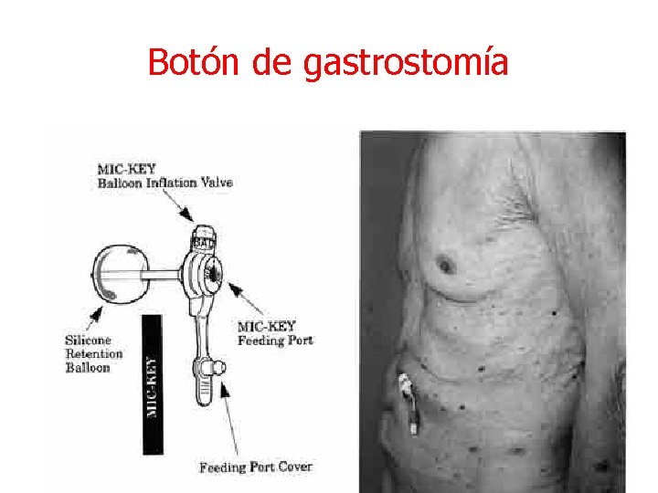 Botón de gastrostomía 