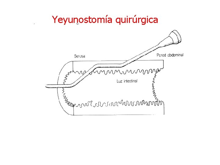 Yeyunostomía quirúrgica 