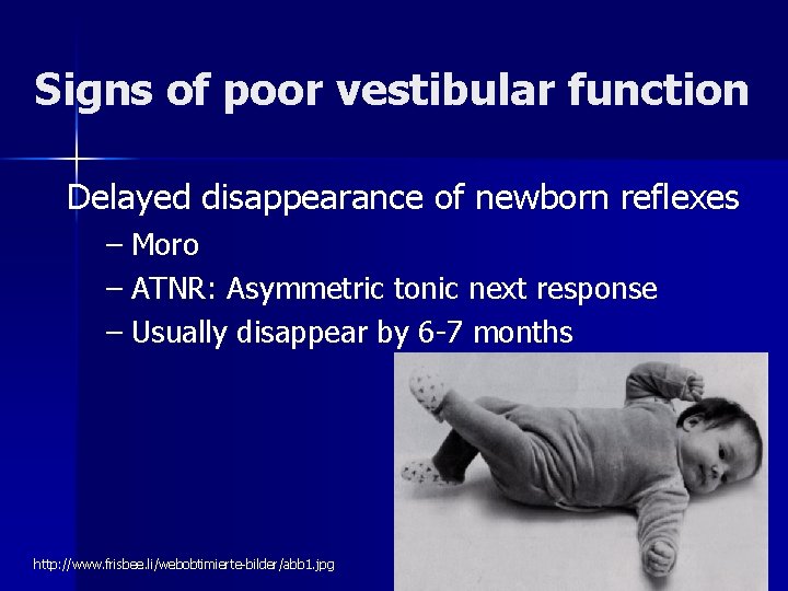 Signs of poor vestibular function Delayed disappearance of newborn reflexes – Moro – ATNR: