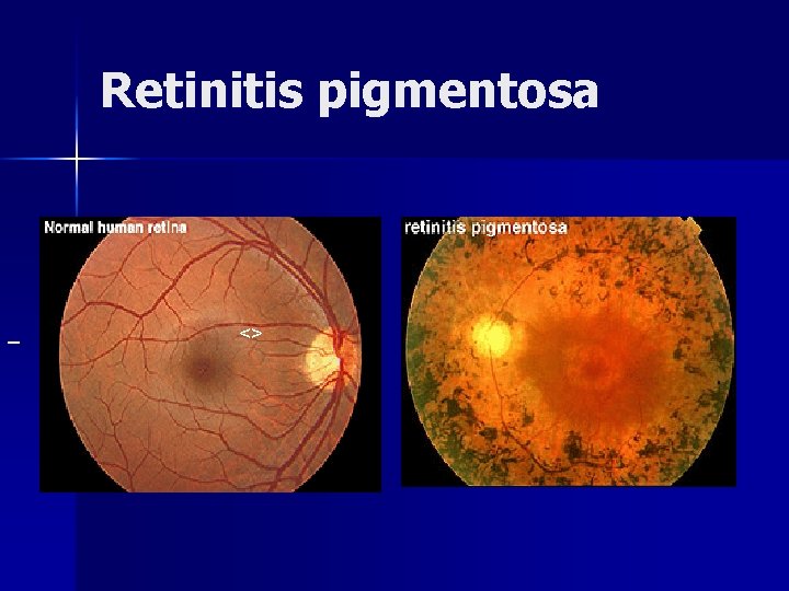 Retinitis pigmentosa <> 