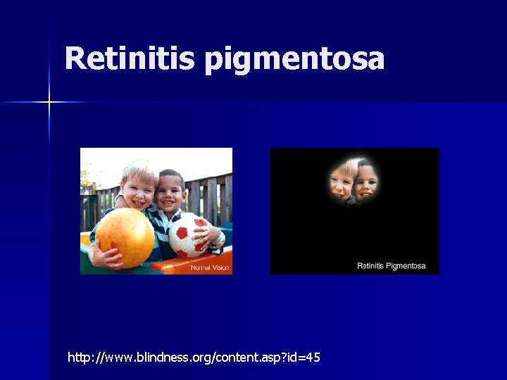 Retinitis pigmentosa http: //www. blindness. org/content. asp? id=45 