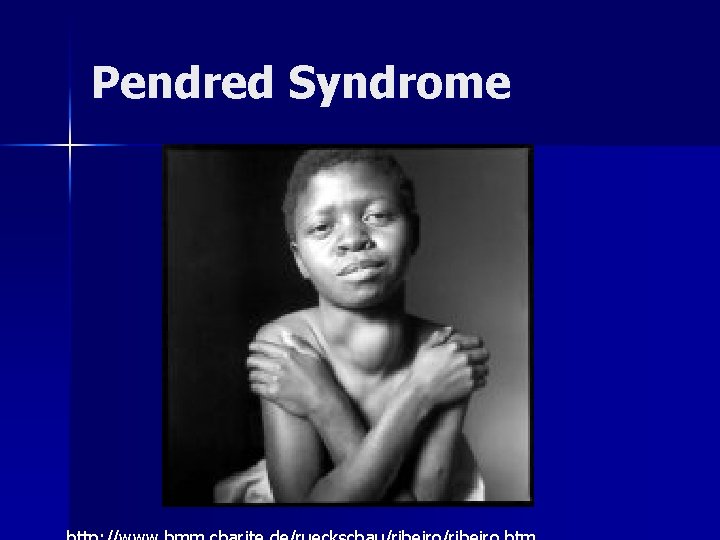 Pendred Syndrome 