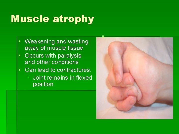Muscle atrophy § Weakening and wasting away of muscle tissue § Occurs with paralysis