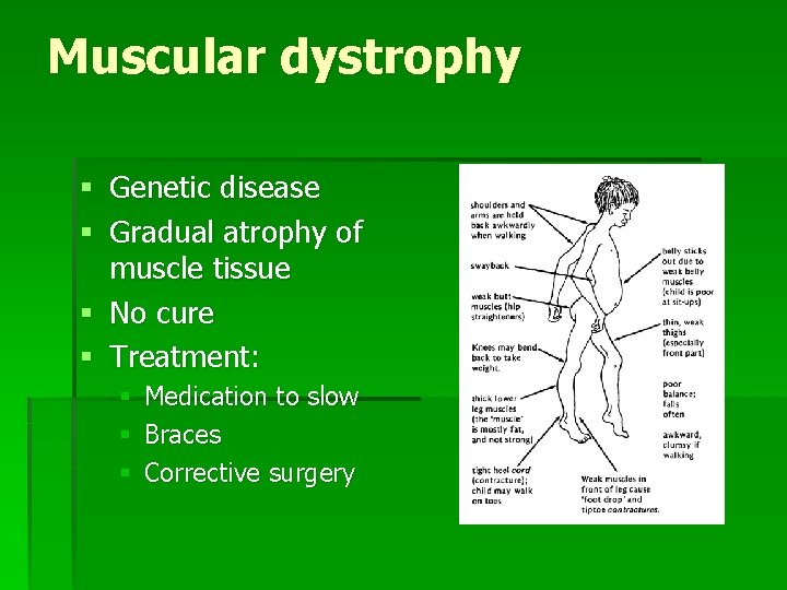 Muscular dystrophy § Genetic disease § Gradual atrophy of muscle tissue § No cure