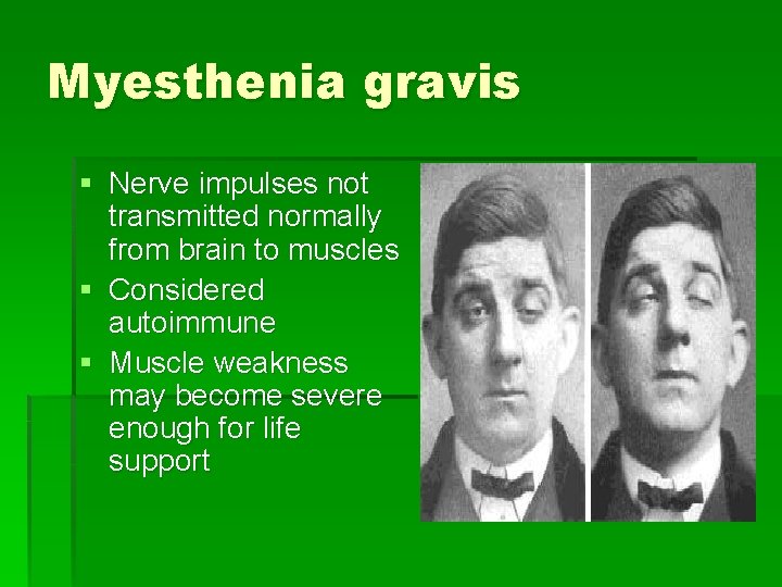 Myesthenia gravis § Nerve impulses not transmitted normally from brain to muscles § Considered