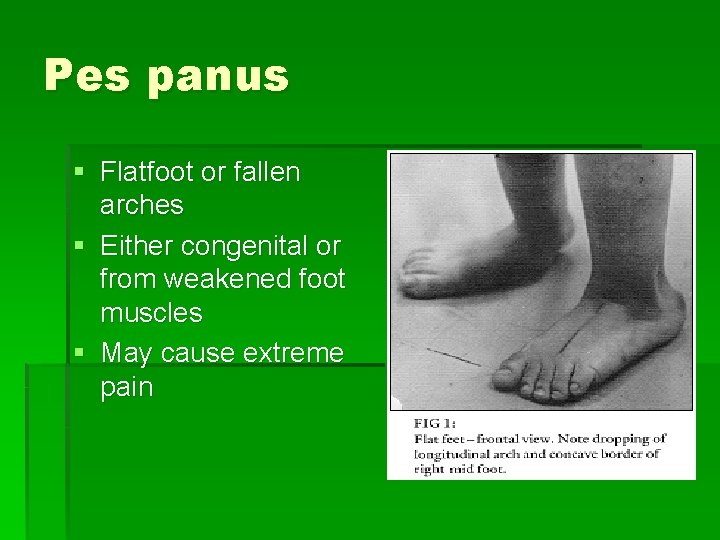 Pes panus § Flatfoot or fallen arches § Either congenital or from weakened foot