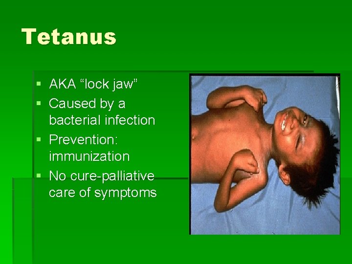Tetanus § AKA “lock jaw” § Caused by a bacterial infection § Prevention: immunization