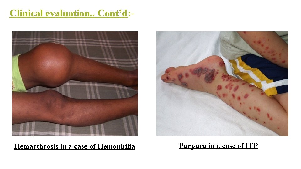 Clinical evaluation. . Cont’d: - Hemarthrosis in a case of Hemophilia Purpura in a