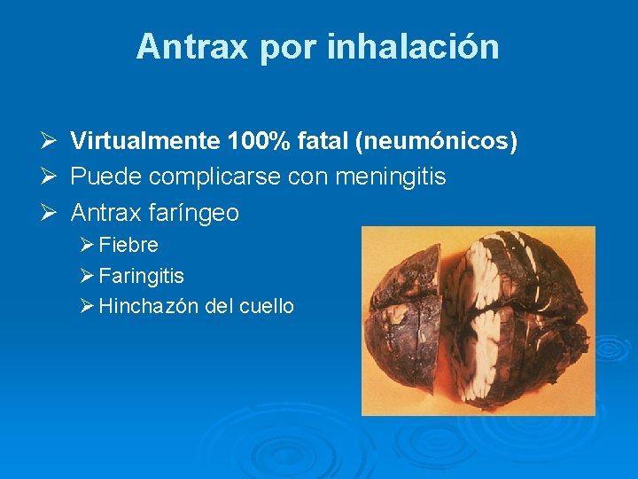 Antrax por inhalación Ø Virtualmente 100% fatal (neumónicos) Ø Puede complicarse con meningitis Ø