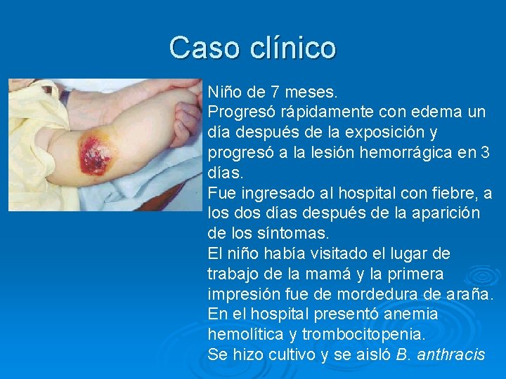 Caso clínico Niño de 7 meses. Progresó rápidamente con edema un día después de