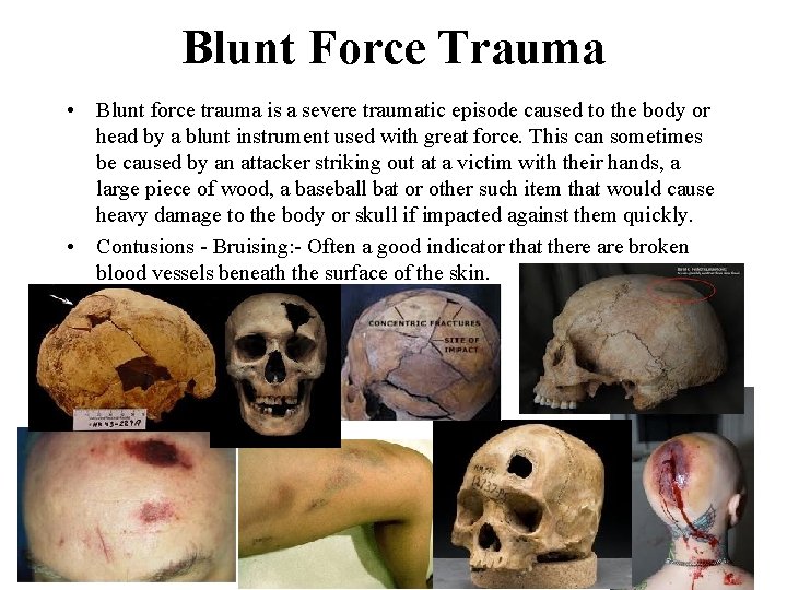 Blunt Force Trauma • Blunt force trauma is a severe traumatic episode caused to