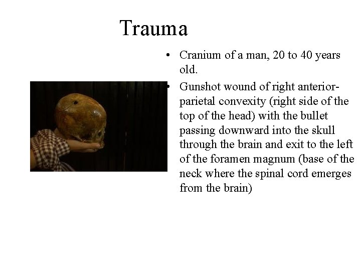 Trauma • Cranium of a man, 20 to 40 years old. • Gunshot wound