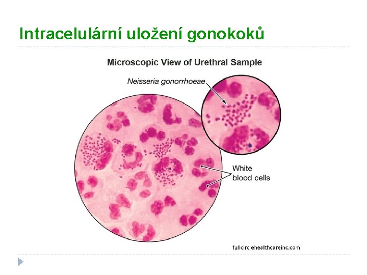 Intracelulární uložení gonokoků 