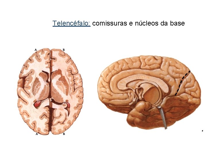 Telencéfalo: comissuras e núcleos da base 