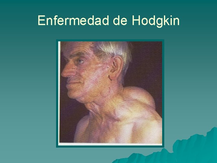 Enfermedad de Hodgkin 