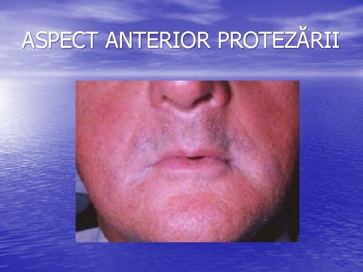 ASPECT ANTERIOR PROTEZĂRII 