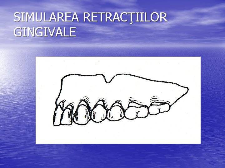 SIMULAREA RETRACŢIILOR GINGIVALE 