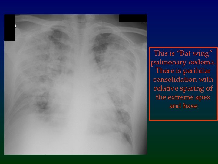 This is “Bat wing” pulmonary oedema. There is perihilar consolidation with relative sparing of