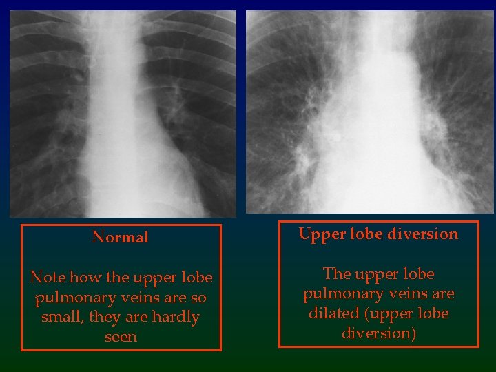 Normal Upper lobe diversion Note how the upper lobe pulmonary veins are so small,