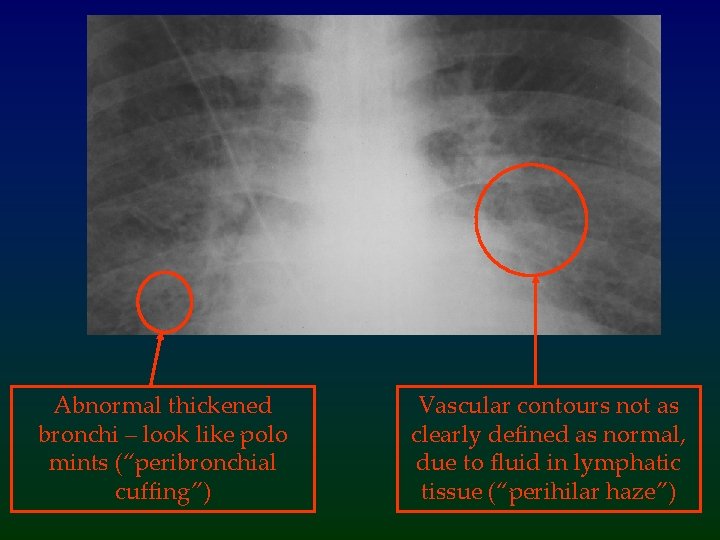 Abnormal thickened bronchi – look like polo mints (“peribronchial cuffing”) Vascular contours not as