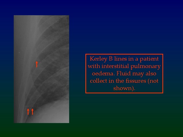 Kerley B lines in a patient with interstitial pulmonary oedema. Fluid may also collect