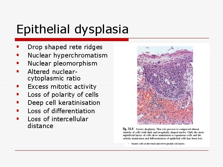 Epithelial dysplasia § § § § § Drop shaped rete ridges Nuclear hyperchromatism Nuclear