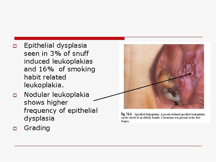 o o o Epithelial dysplasia seen in 3% of snuff induced leukoplakias and 16%