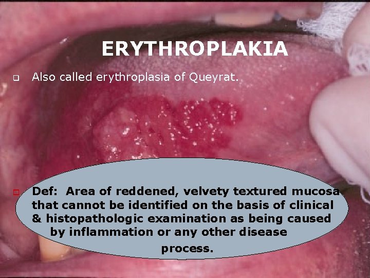 ERYTHROPLAKIA q o Also called erythroplasia of Queyrat. Def: Area of reddened, velvety textured