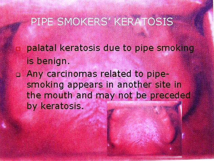 PIPE SMOKERS’ KERATOSIS o q palatal keratosis due to pipe smoking is benign. Any