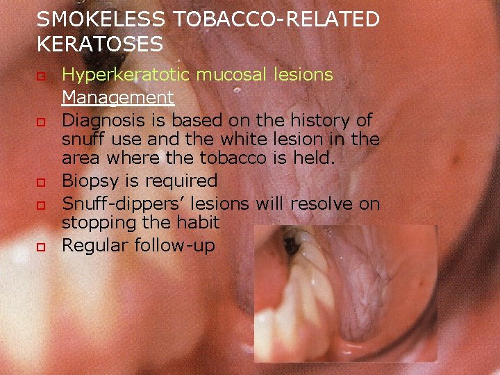 SMOKELESS TOBACCO-RELATED KERATOSES o o o Hyperkeratotic mucosal lesions Management Diagnosis is based on