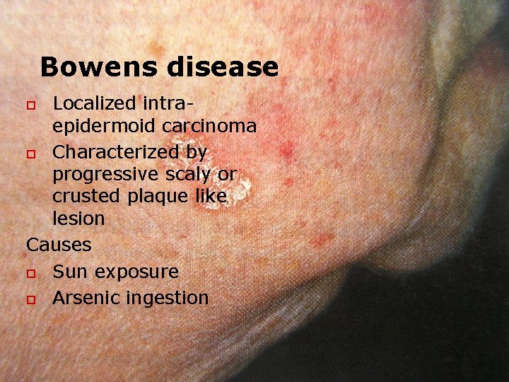 Bowens disease Localized intraepidermoid carcinoma o Characterized by progressive scaly or crusted plaque like