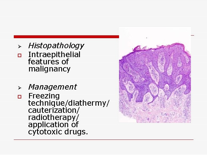 Ø o Histopathology Intraepithelial features of malignancy Management Freezing technique/diathermy/ cauterization/ radiotherapy/ application of