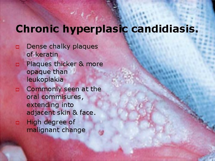 Chronic hyperplasic candidiasis. o o Dense chalky plaques of keratin Plaques thicker & more