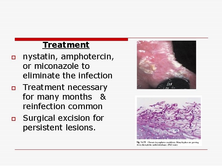 o o o Treatment nystatin, amphotercin, or miconazole to eliminate the infection Treatment necessary