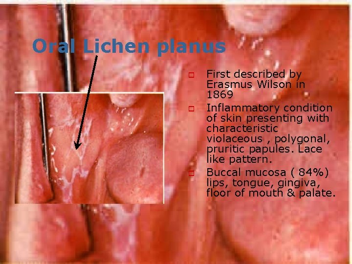 Oral Lichen planus o o o First described by Erasmus Wilson in 1869 Inflammatory