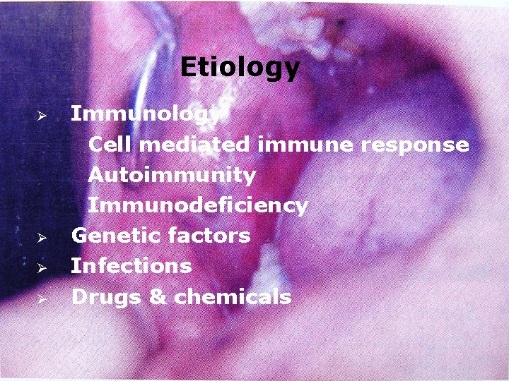 Etiology Ø Ø Immunology Cell mediated immune response Autoimmunity Immunodeficiency Genetic factors Infections Drugs