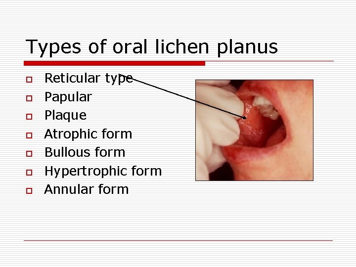 Types of oral lichen planus o o o o Reticular type Papular Plaque Atrophic