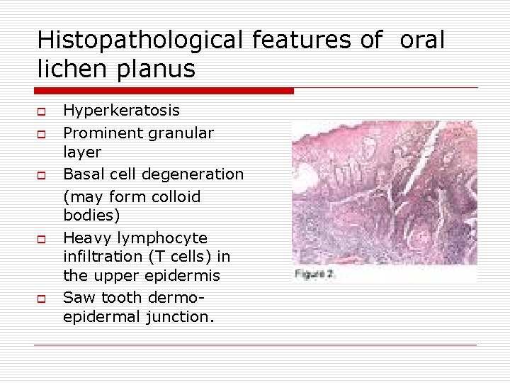 Histopathological features of oral lichen planus o o o Hyperkeratosis Prominent granular layer Basal