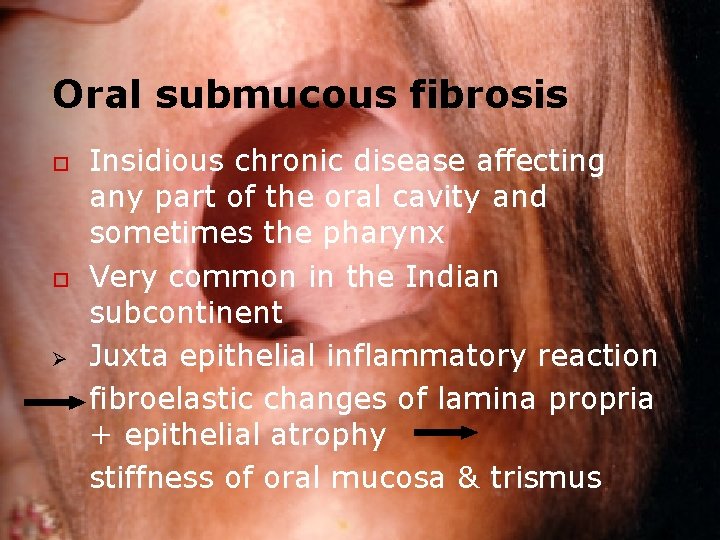 Oral submucous fibrosis o o Ø Insidious chronic disease affecting any part of the