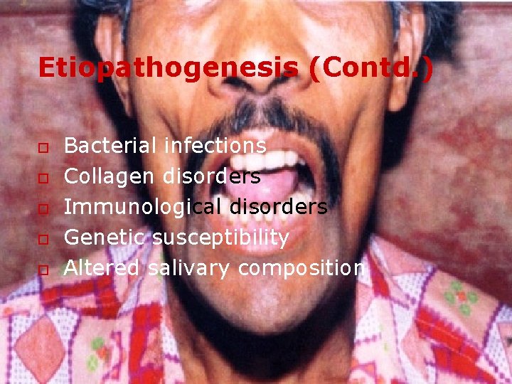 Etiopathogenesis (Contd. ) o o o Bacterial infections Collagen disorders Immunological disorders Genetic susceptibility