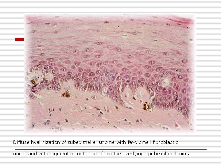 Diffuse hyalinization of subepithelial stroma with few, small fibroblastic nuclei and with pigment incontinence