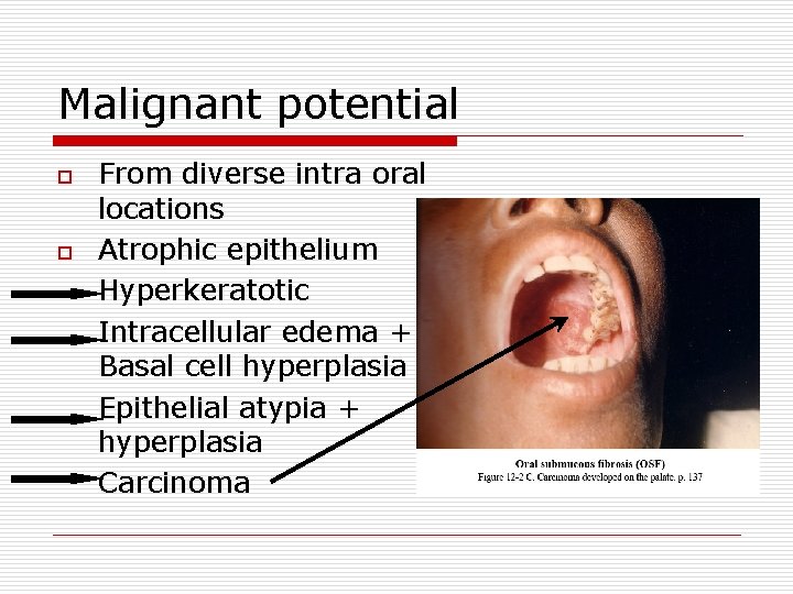 Malignant potential o o From diverse intra oral locations Atrophic epithelium Hyperkeratotic Intracellular edema