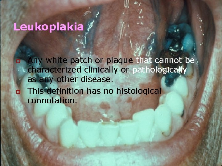 Leukoplakia o o Any white patch or plaque that cannot be characterized clinically or